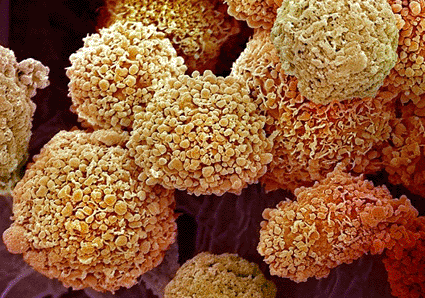 Image: Colored scanning electron micrograph (SEM) of breast cancer cells (photo courtesy  Steve Gschmeissner / Science Photo Library).